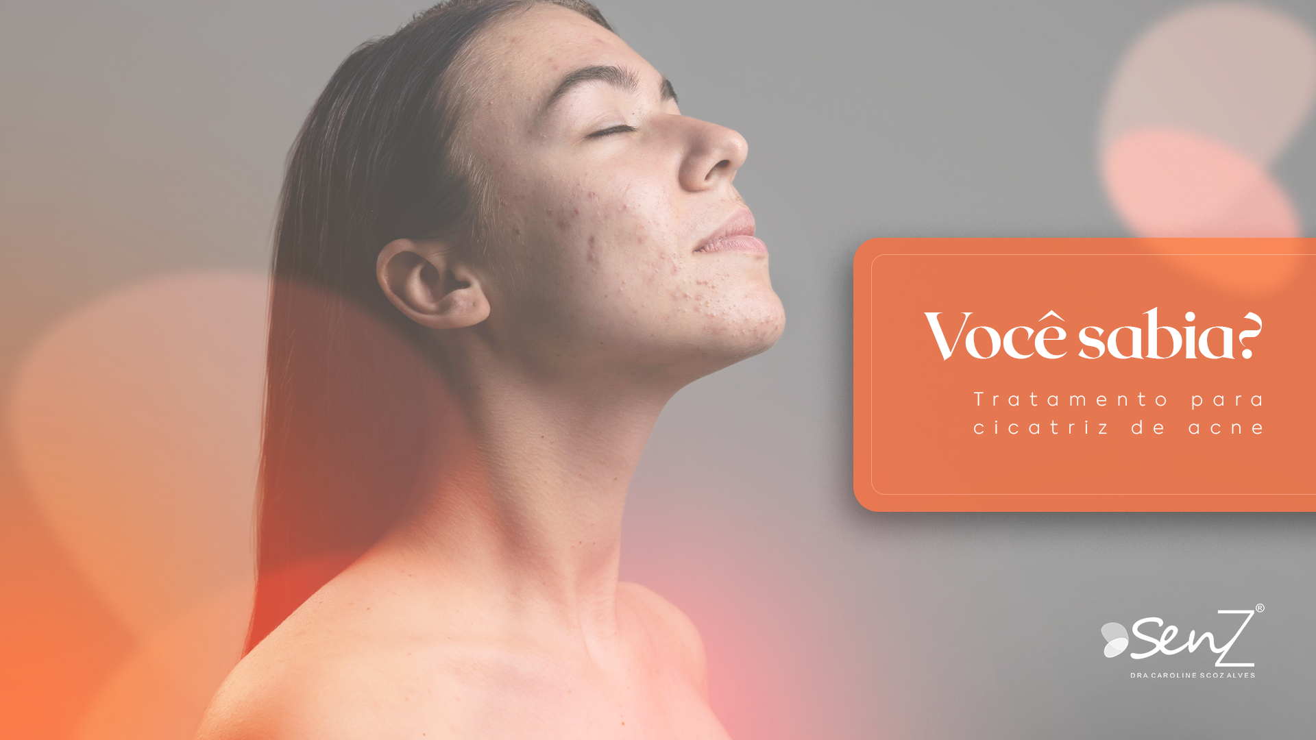 Tratamento de Acne Ativa